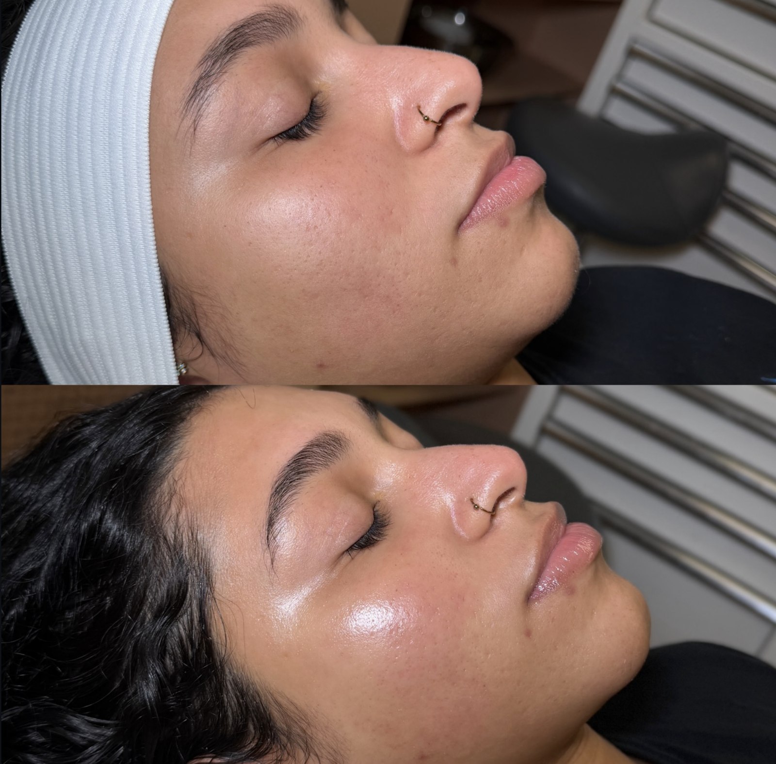 Before and after facial treatment by Sia Miller
