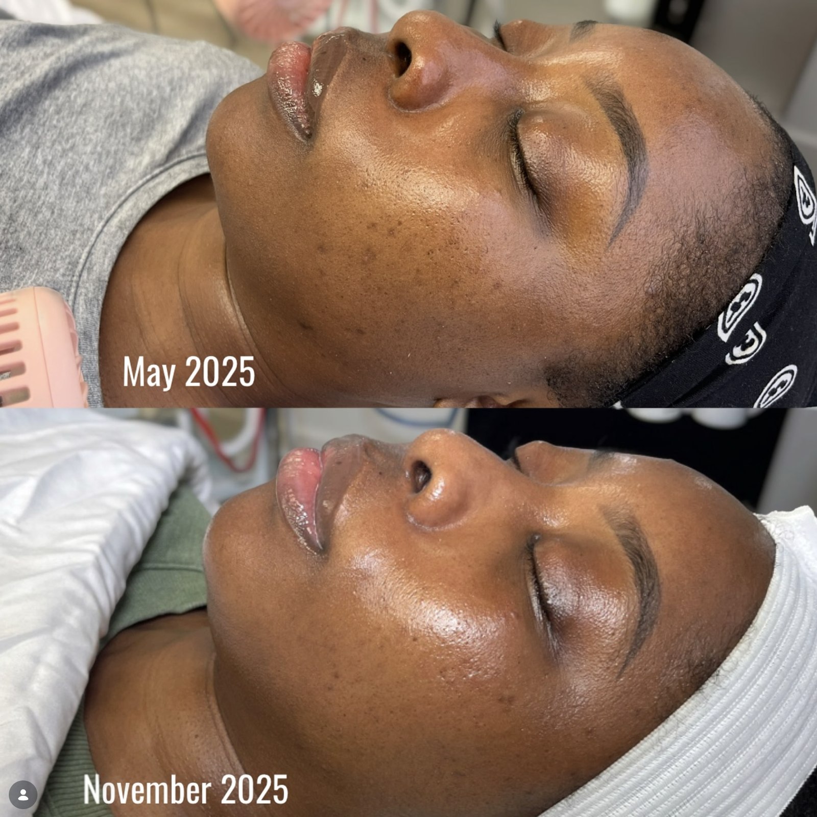 Progress from May 2025 to November 2025 — facial treatments by Sia Miller
