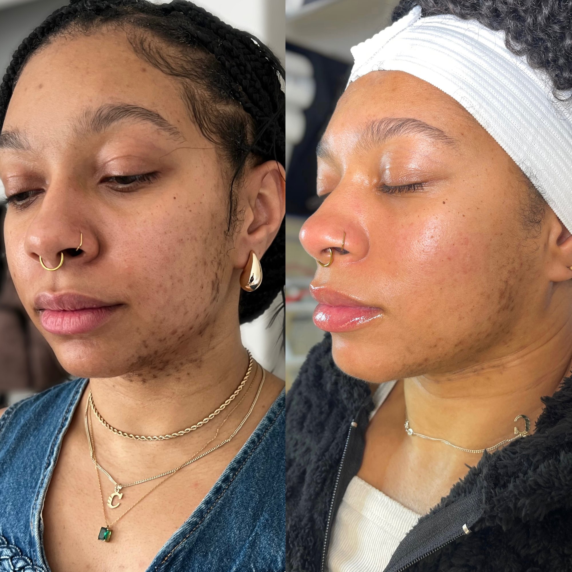 Before and after — hyperpigmentation treatment by Sia Miller
