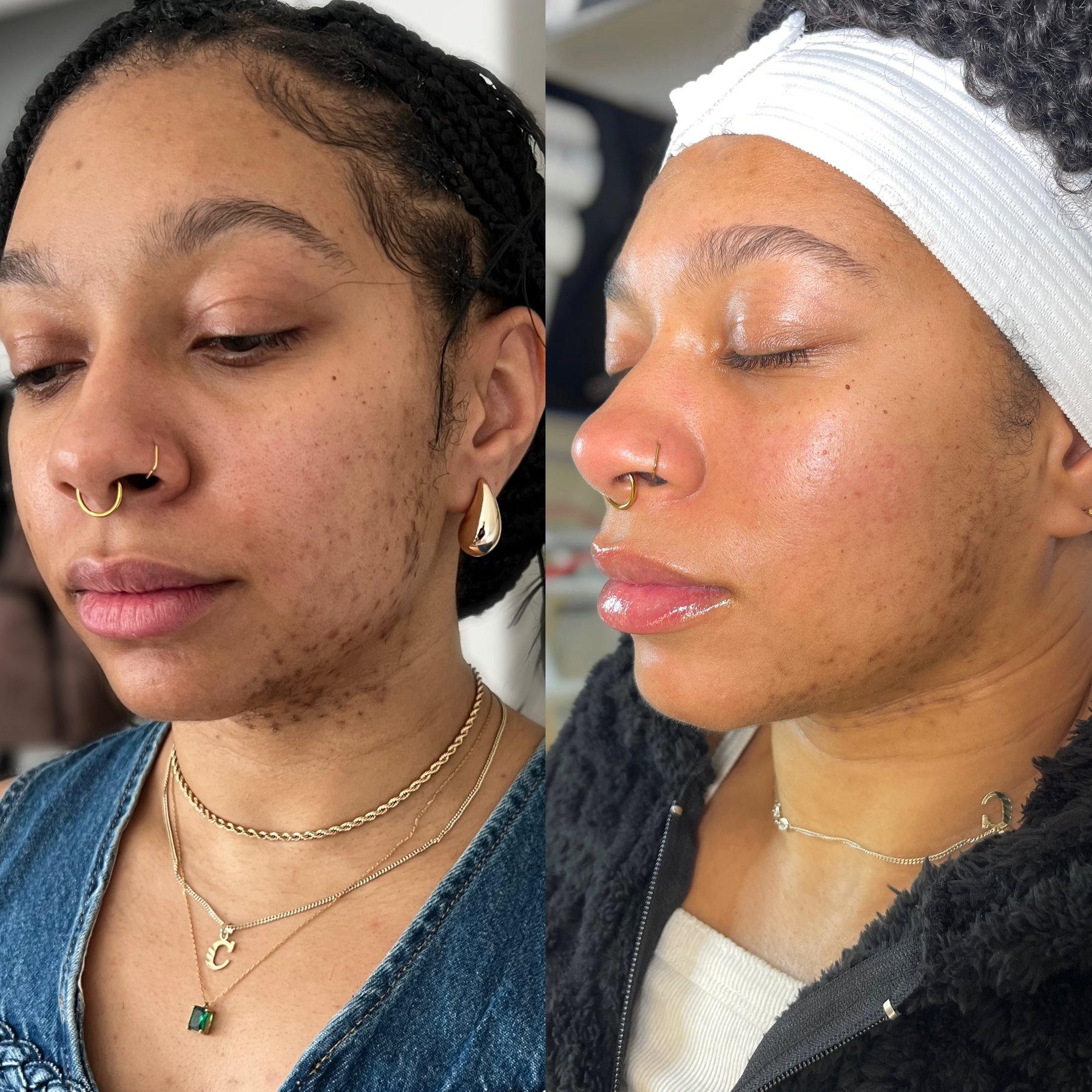 Before and after — one year of facials on a Face Reality routine with peels every three weeks, by Sia Mia